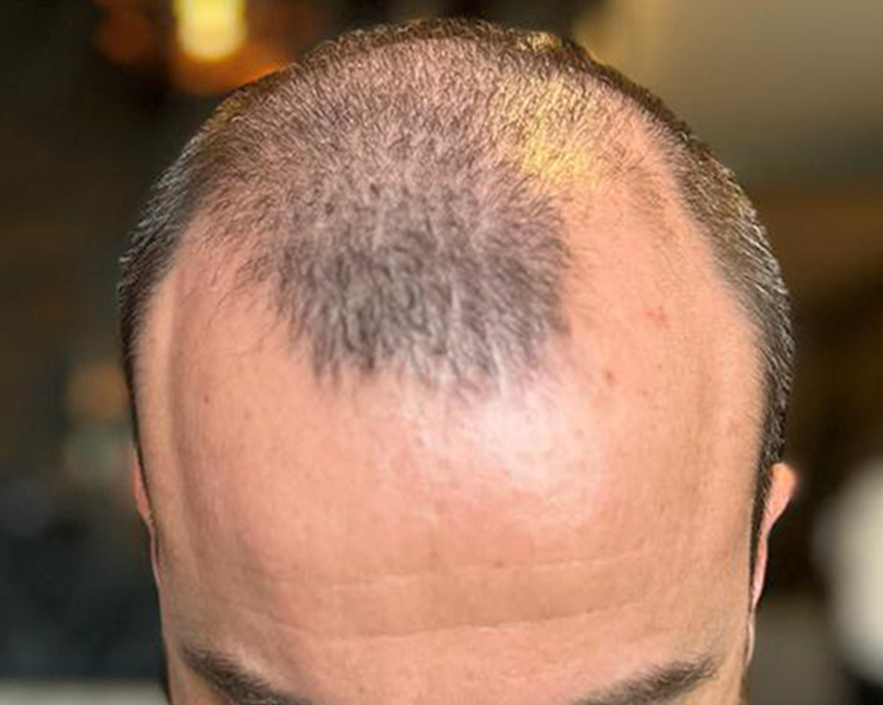 Antes
