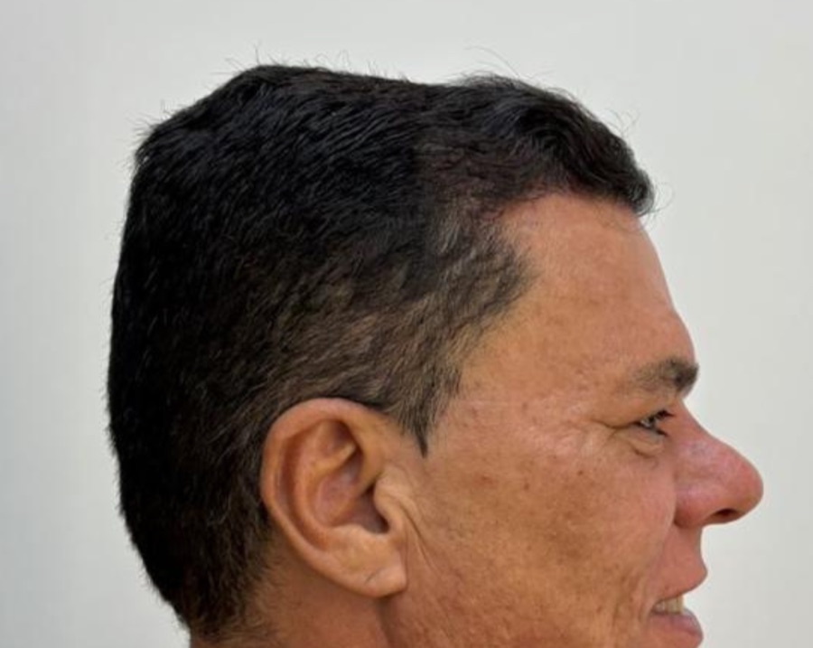 Resultado depois — caso 1